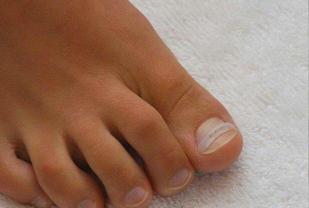 Nail Bracing to treat ingrown toenails