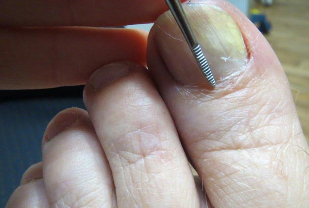 Discolouration of a fungal infection - Toenail Problems - toenail treatments bundaberg