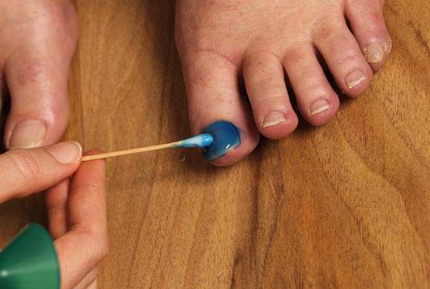 PACT Therapy for toenail problems